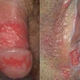 Illustration for article titled Obat Penyakit Herpes Kelamin